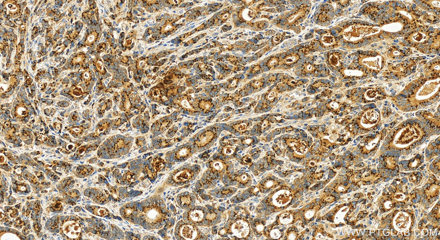 Immunohistochemistry (IHC) staining of human stomach cancer tissue using FAM3D Polyclonal antibody (12336-1-AP)