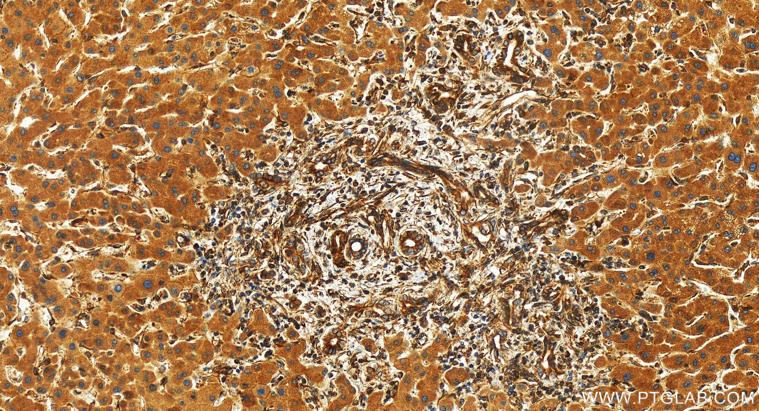 Immunohistochemistry (IHC) staining of human intrahepatic cholangiocarcinoma tissue using ESYT2 Polyclonal antibody (24385-1-AP)