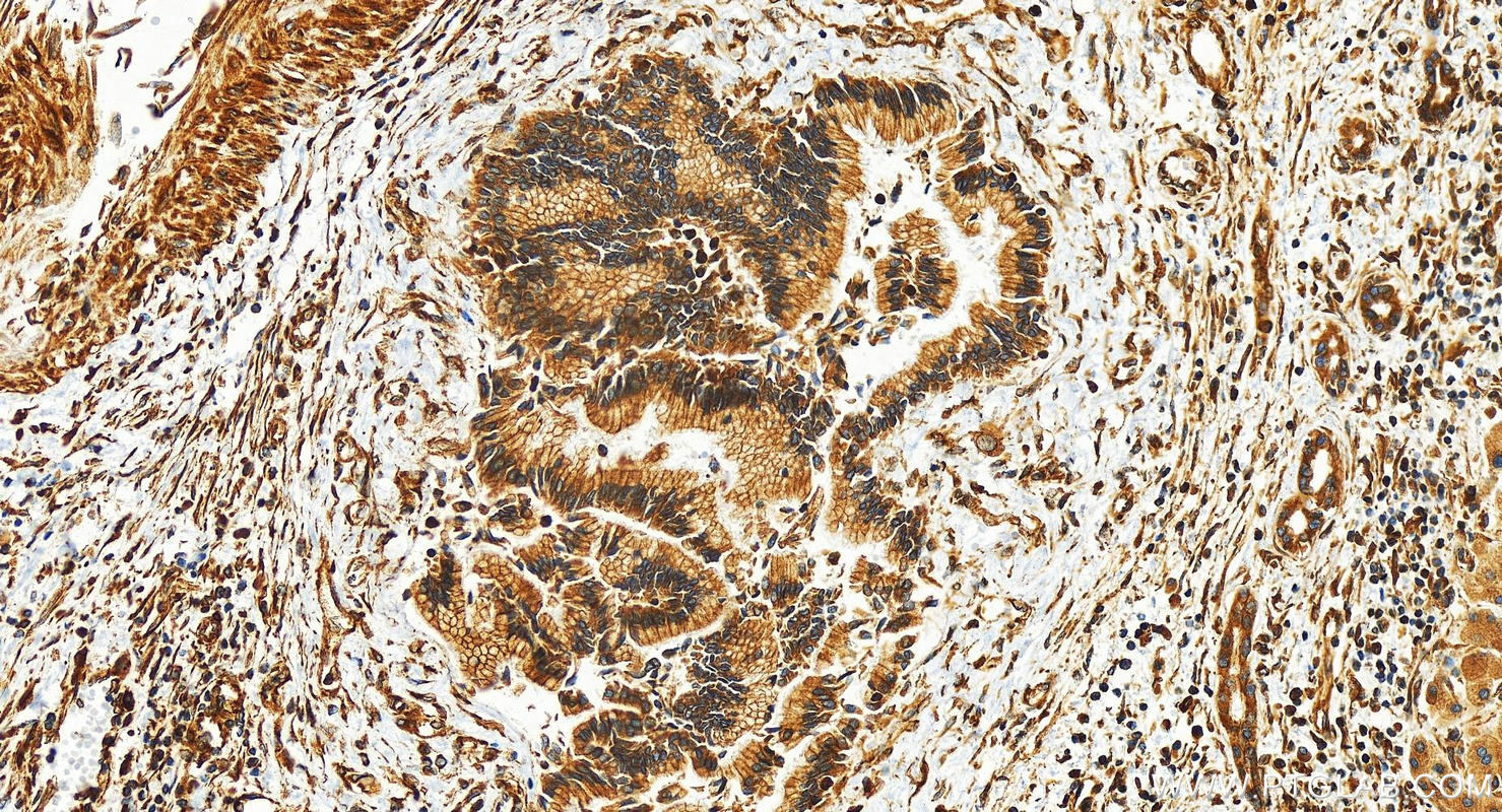 Immunohistochemistry (IHC) staining of human intrahepatic cholangiocarcinoma tissue using ESYT2 Polyclonal antibody (24385-1-AP)