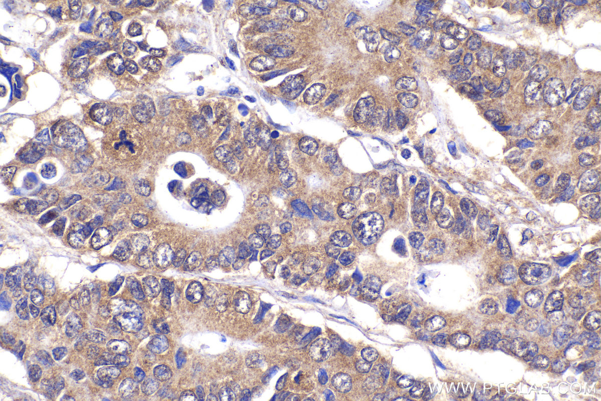 Immunohistochemistry (IHC) staining of human stomach cancer tissue using FANCA Polyclonal antibody (11975-1-AP)