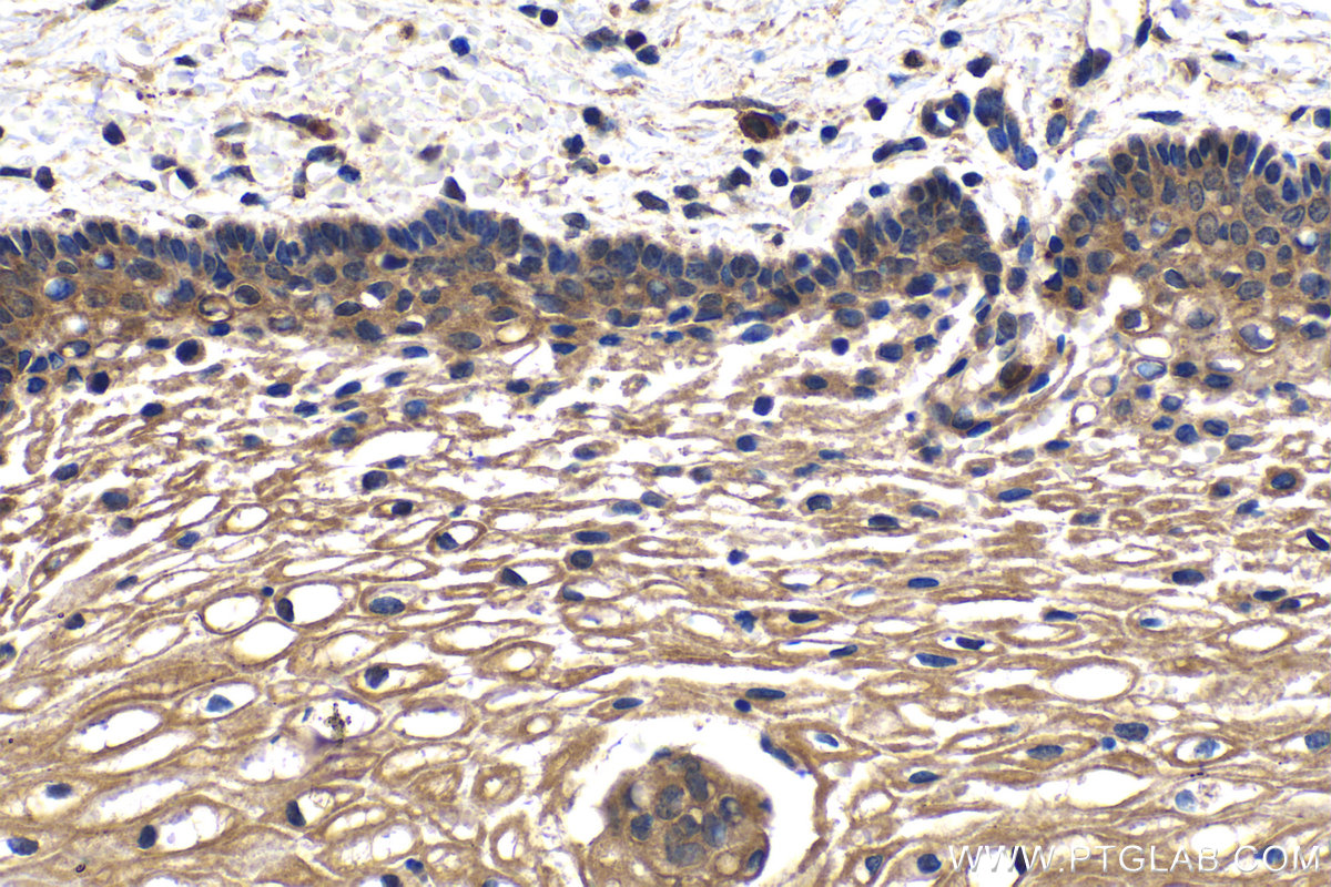 Immunohistochemistry (IHC) staining of human cervical cancer tissue using FANCA Polyclonal antibody (11975-1-AP)