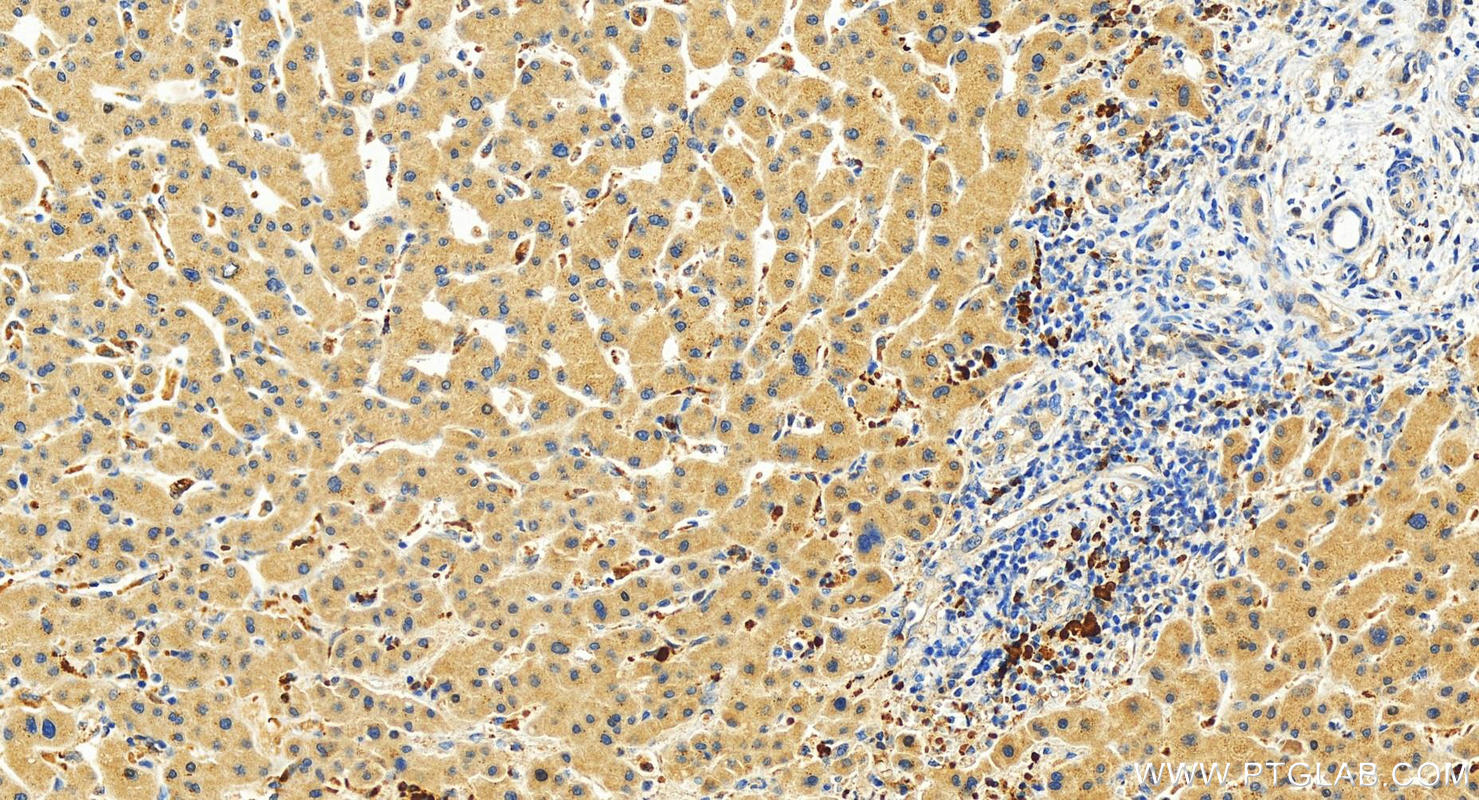 Immunohistochemistry (IHC) staining of human intrahepatic cholangiocarcinoma tissue using FANCI Polyclonal antibody (20789-1-AP)