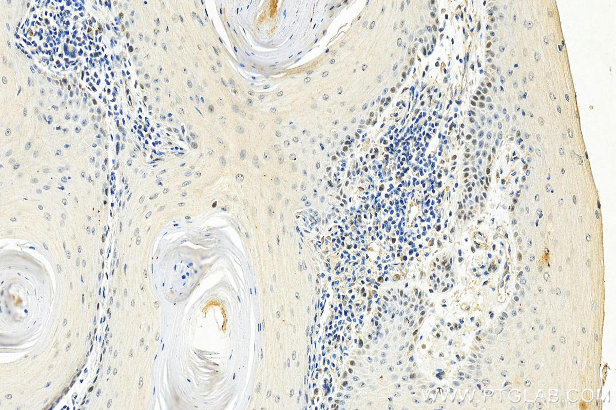 Immunohistochemistry (IHC) staining of human skin cancer tissue using FANCI Monoclonal antibody (67304-1-Ig)