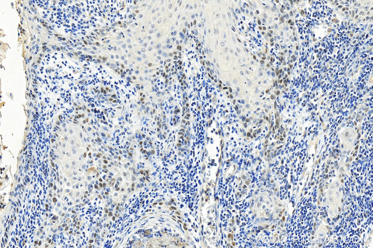 Immunohistochemistry (IHC) staining of human skin cancer tissue using FANCI Monoclonal antibody (67304-1-Ig)