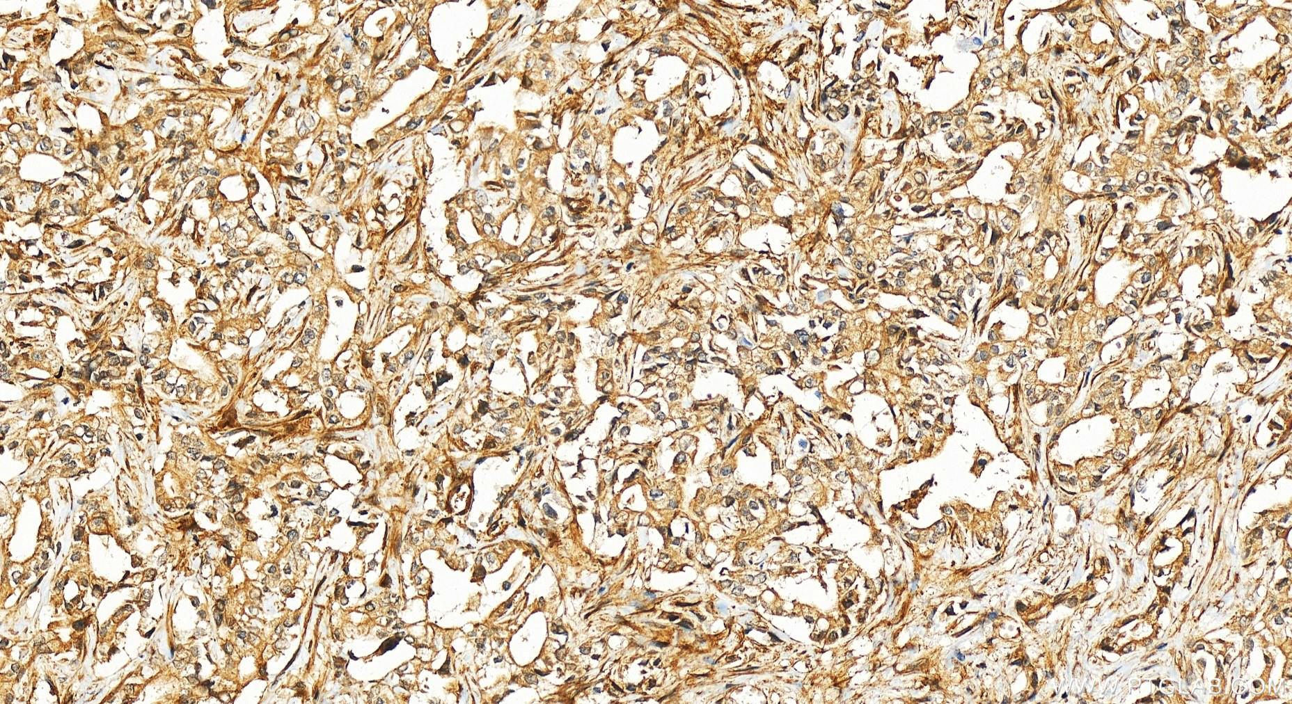 Immunohistochemistry (IHC) staining of human intrahepatic cholangiocarcinoma tissue using FAPA Polyclonal antibody (11779-1-AP)