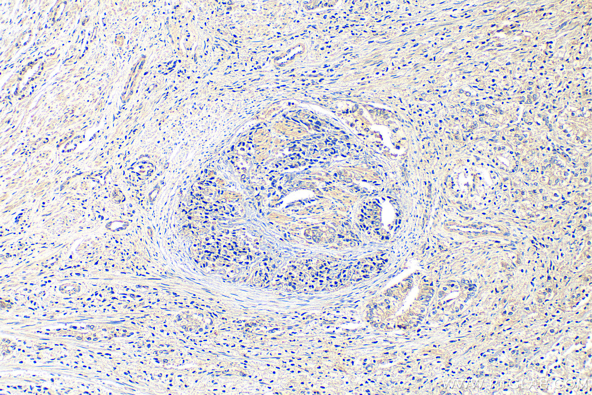 Immunohistochemistry (IHC) staining of human prostate hyperplasia tissue using FAT1 Polyclonal antibody (30733-1-AP)