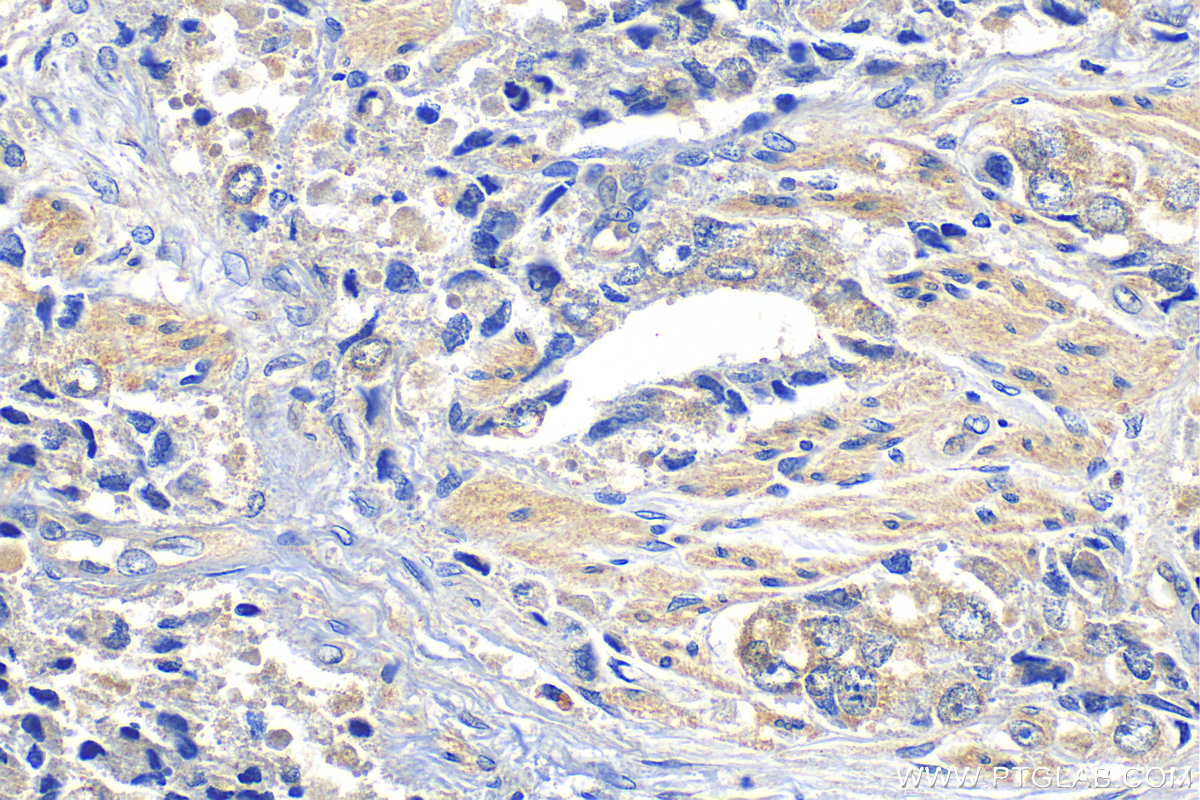 Immunohistochemistry (IHC) staining of human prostate hyperplasia tissue using FAT1 Polyclonal antibody (30733-1-AP)