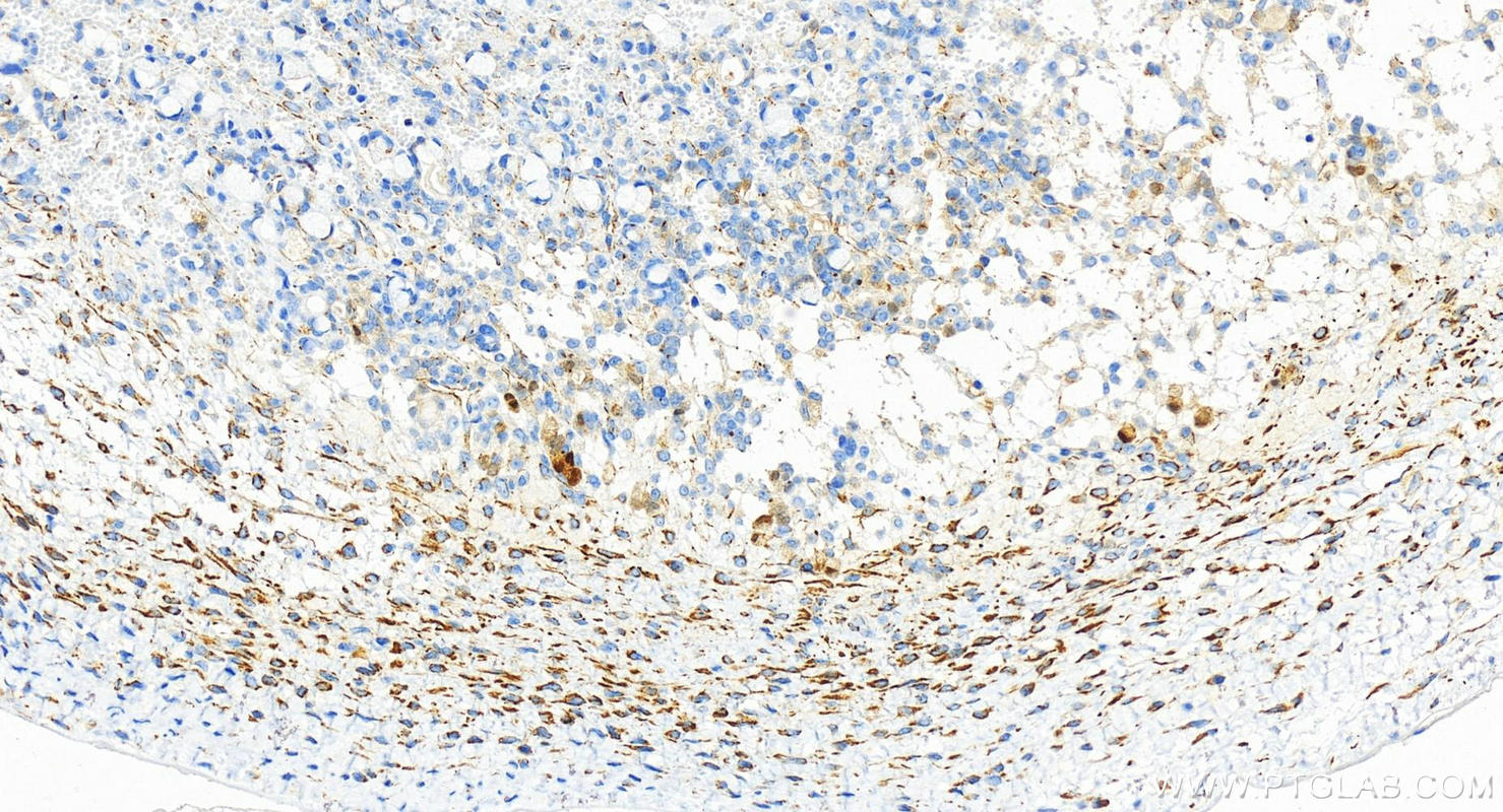 Immunohistochemistry (IHC) staining of human ovary cancer tissue using FBP2 Recombinant antibody (83910-5-RR)