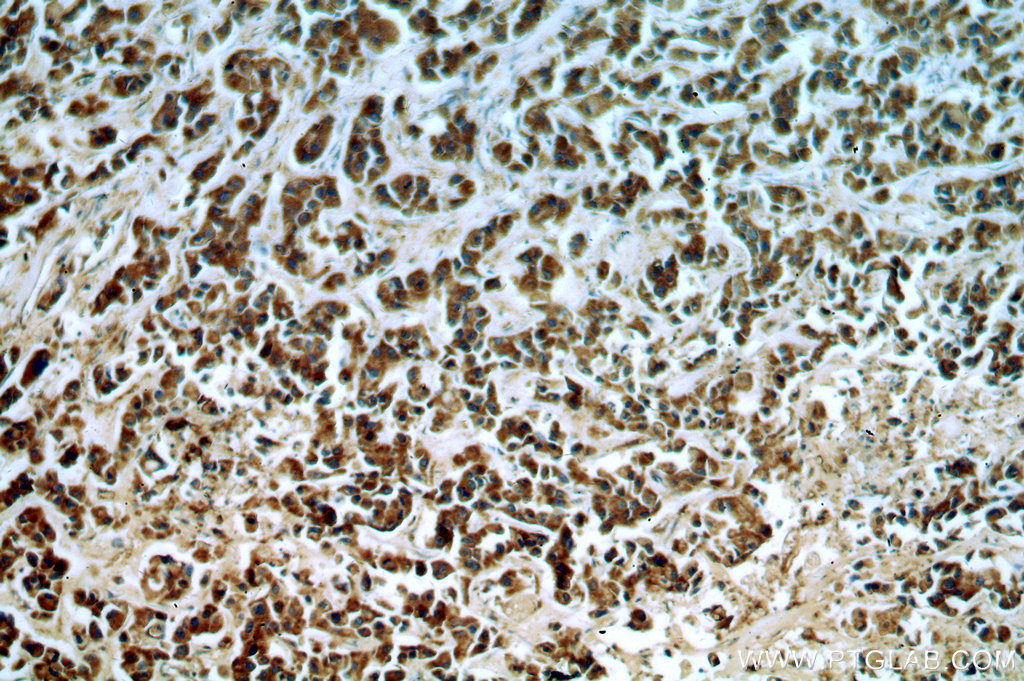 Immunohistochemistry (IHC) staining of human breast cancer tissue using fibrosin Polyclonal antibody (11356-1-AP)