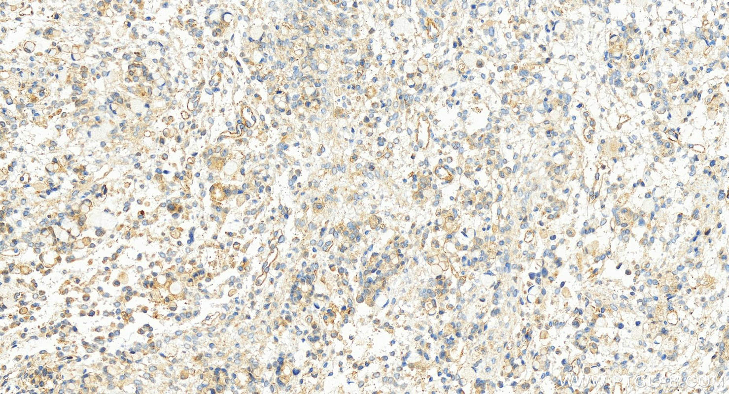 Immunohistochemistry (IHC) staining of human ovary cancer tissue using FBX15 Polyclonal antibody (13024-1-AP)