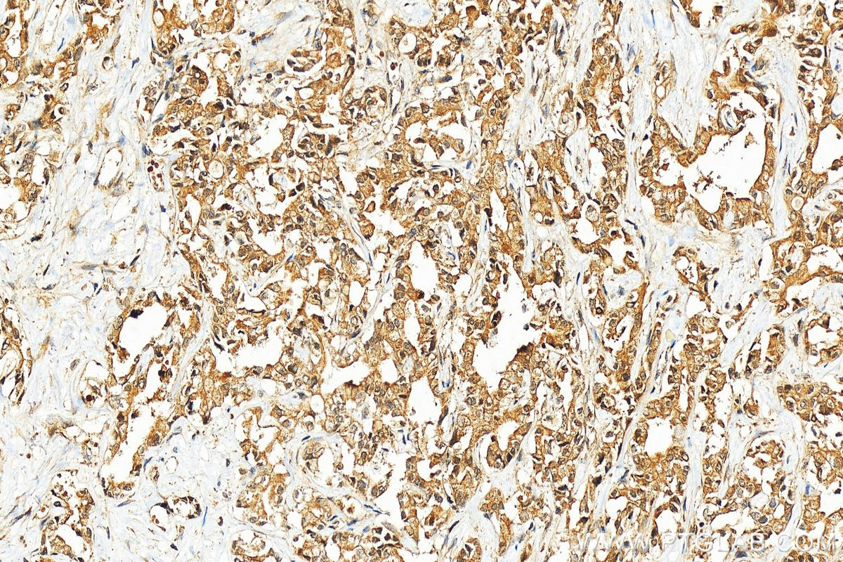 Immunohistochemistry (IHC) staining of human intrahepatic cholangiocarcinoma tissue using FBXO7 Polyclonal antibody (10696-1-AP)