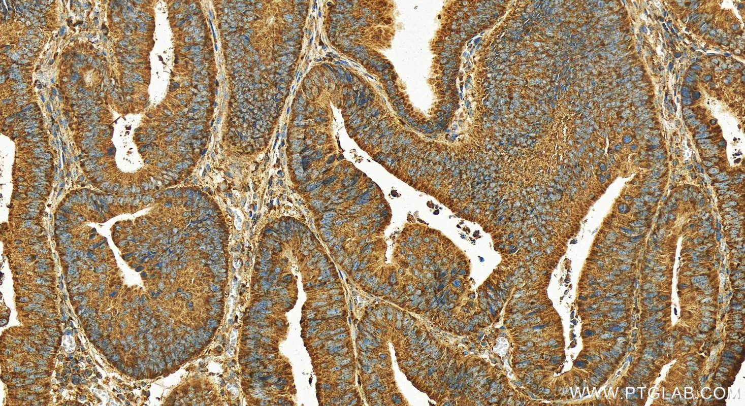 Immunohistochemistry (IHC) staining of human colon cancer tissue using FBXW2 Polyclonal antibody (11499-1-AP)