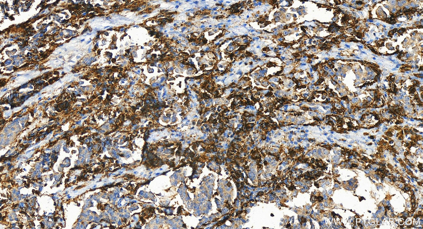 Immunohistochemistry (IHC) staining of human ovary cancer tissue using FcRγ Polyclonal antibody (13566-1-AP)