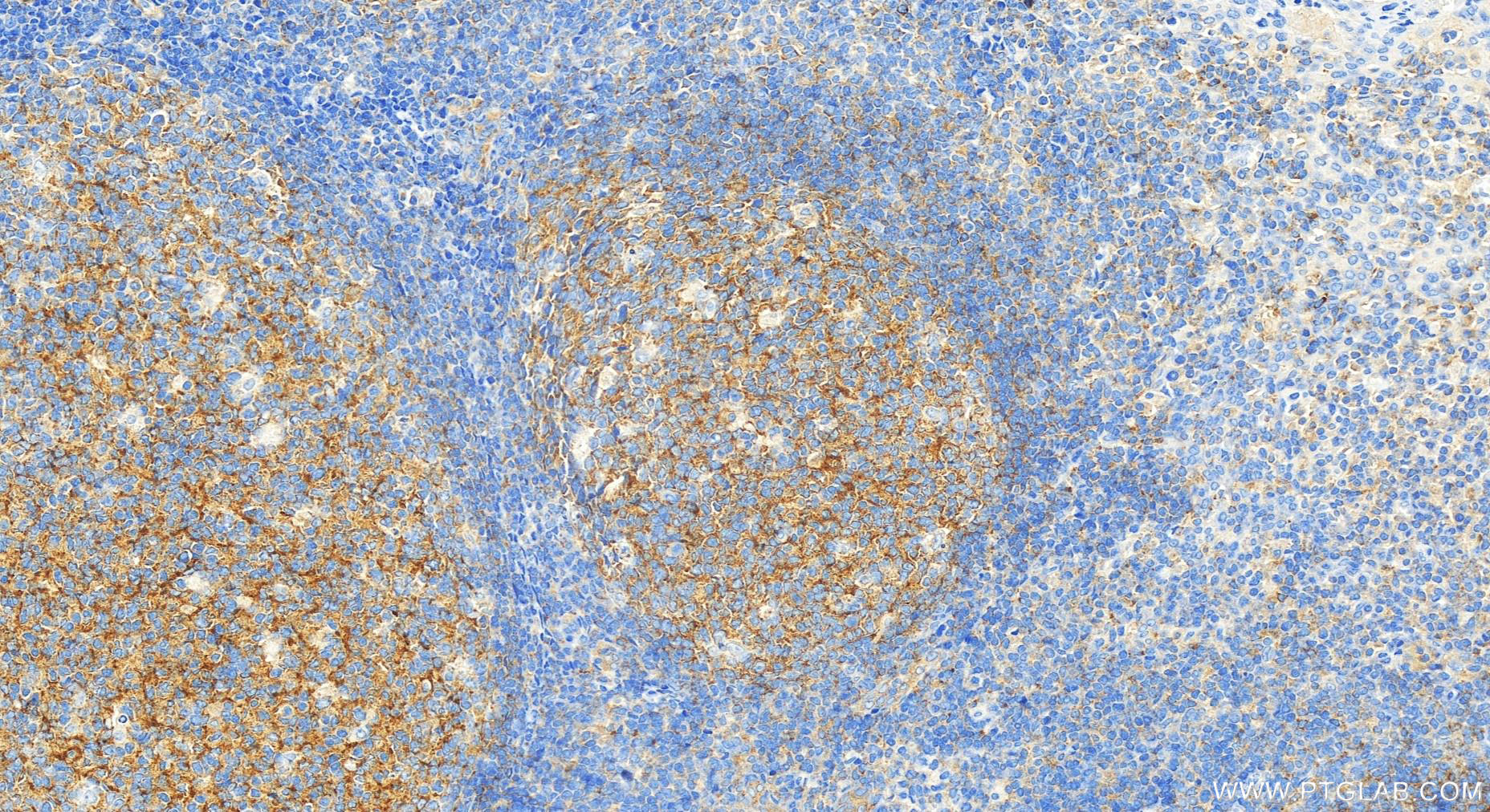 Immunohistochemistry (IHC) staining of human tonsillitis tissue using FCHO1 Polyclonal antibody (26767-1-AP)