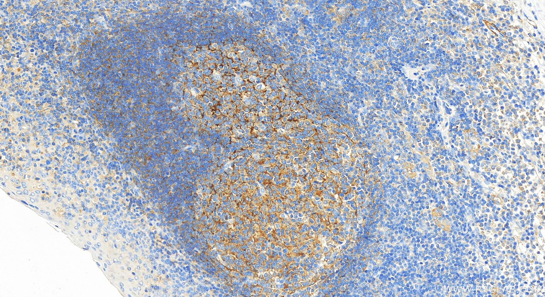 Immunohistochemistry (IHC) staining of human tonsillitis tissue using FCHO1 Polyclonal antibody (26767-1-AP)