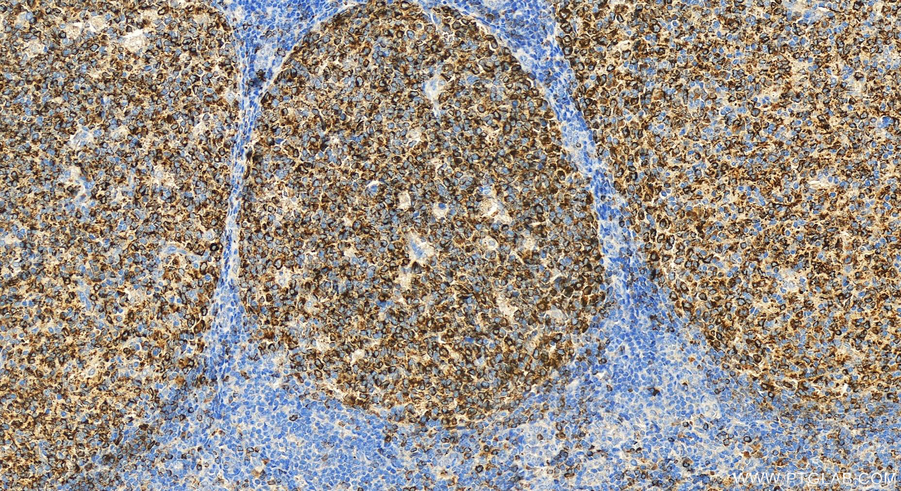 Immunohistochemistry (IHC) staining of human tonsillitis tissue using FCRLA Polyclonal antibody (26949-1-AP)