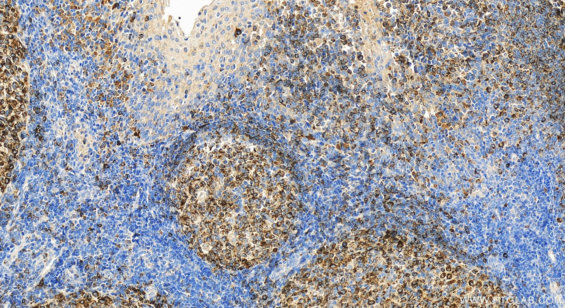 Immunohistochemistry (IHC) staining of human tonsillitis tissue using FCRLA Polyclonal antibody (26949-1-AP)