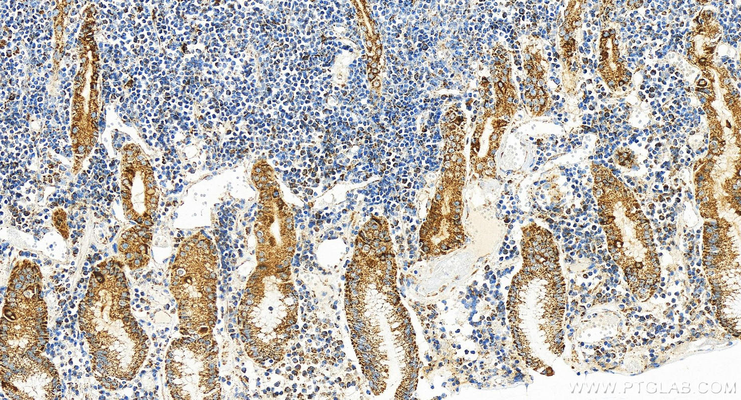 Immunohistochemistry (IHC) staining of human stomach cancer tissue using FDX1 Recombinant antibody (82957-1-RR)