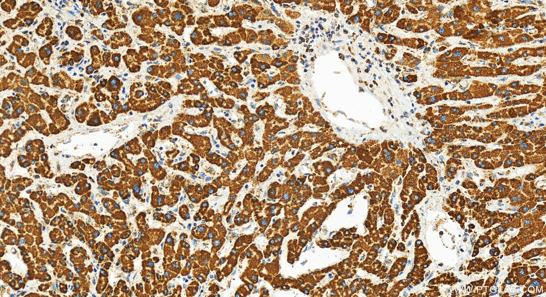 Immunohistochemistry (IHC) staining of human intrahepatic cholangiocarcinoma tissue using FDX1 Recombinant antibody (82957-1-RR)