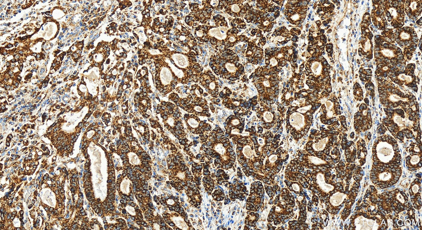 Immunohistochemistry (IHC) staining of human stomach cancer tissue using FDX1 Recombinant antibody (82957-2-RR)