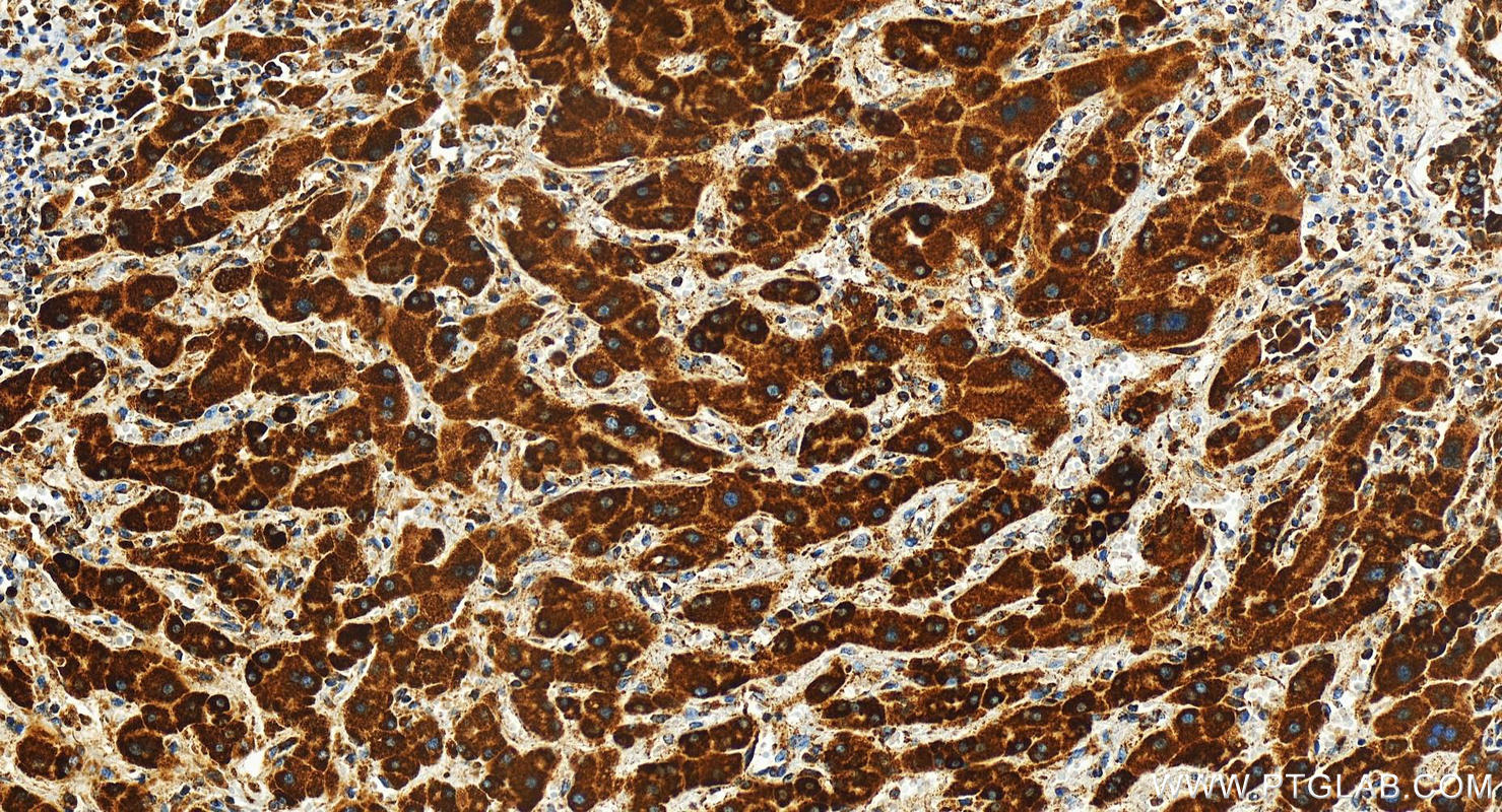 Immunohistochemistry (IHC) staining of human intrahepatic cholangiocarcinoma tissue using FDX1 Recombinant antibody (82957-2-RR)