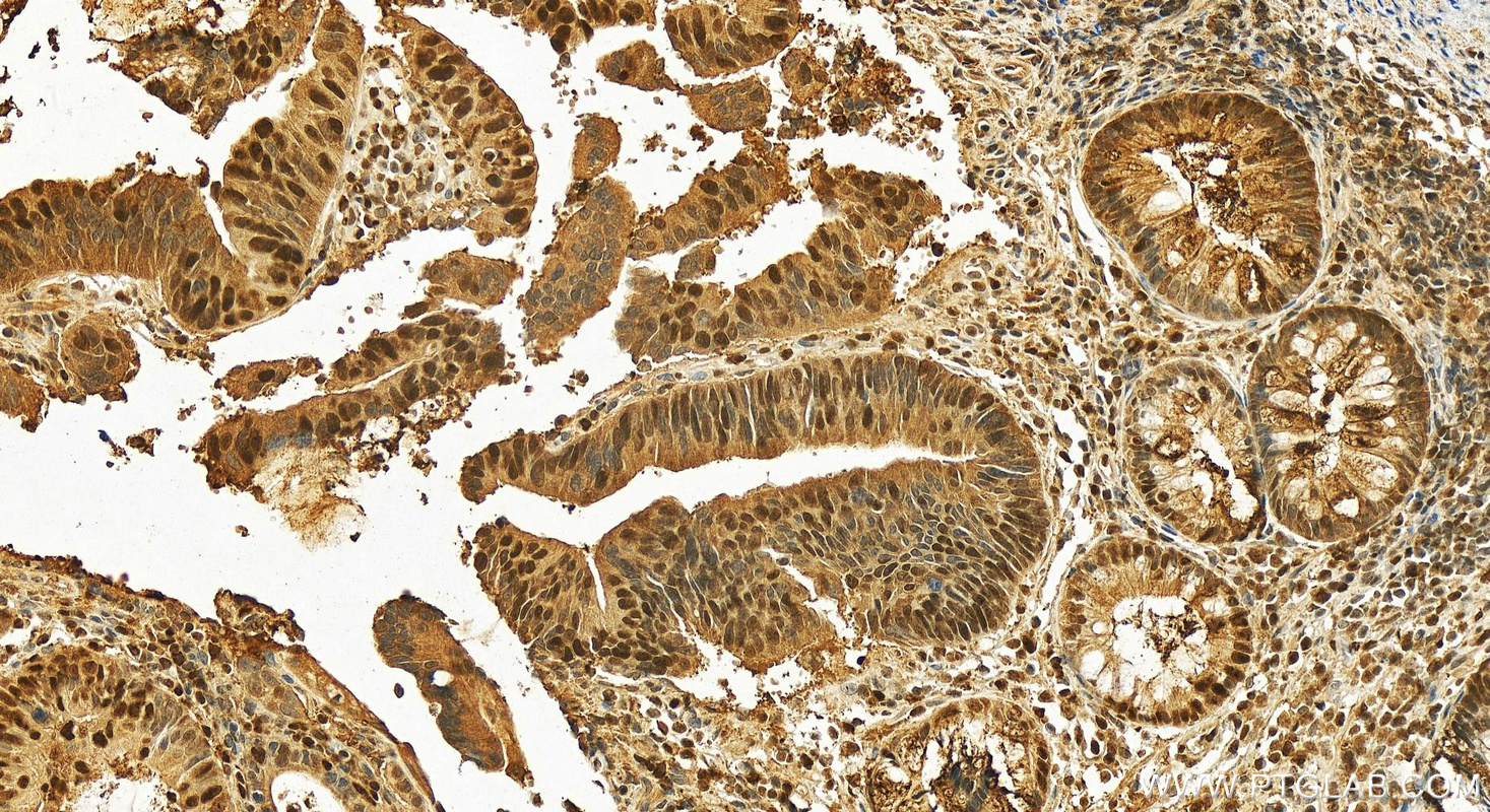 Immunohistochemistry (IHC) staining of human colon cancer tissue using FEN1 Polyclonal antibody (14768-1-AP)