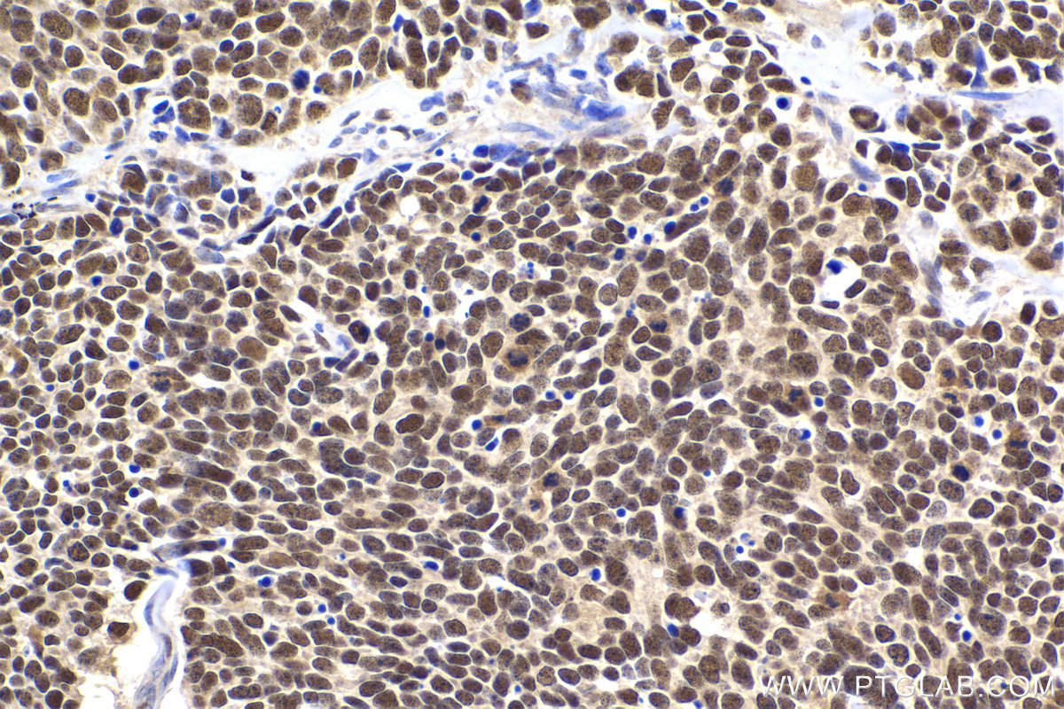 Immunohistochemistry (IHC) staining of human lung cancer tissue using FEN1 Polyclonal antibody (14768-1-AP)