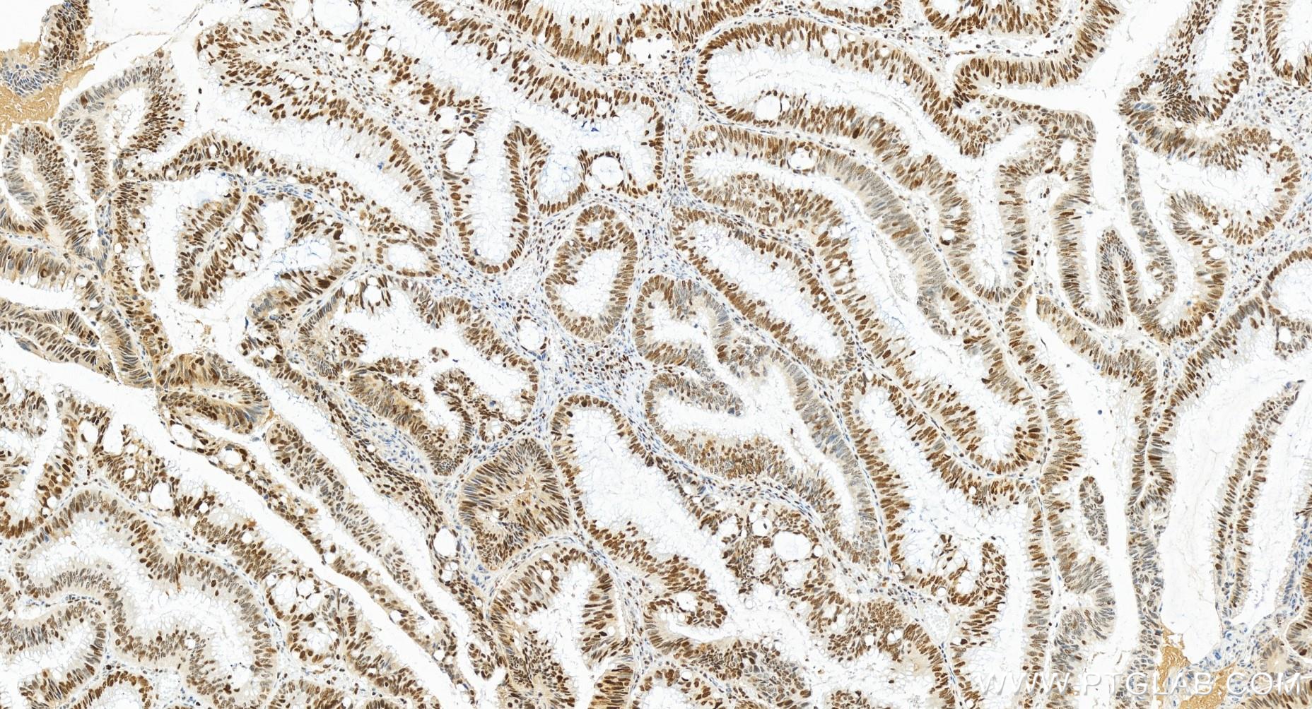 Immunohistochemistry (IHC) staining of human colon cancer tissue using FEN1 Recombinant antibody (84916-5-RR)