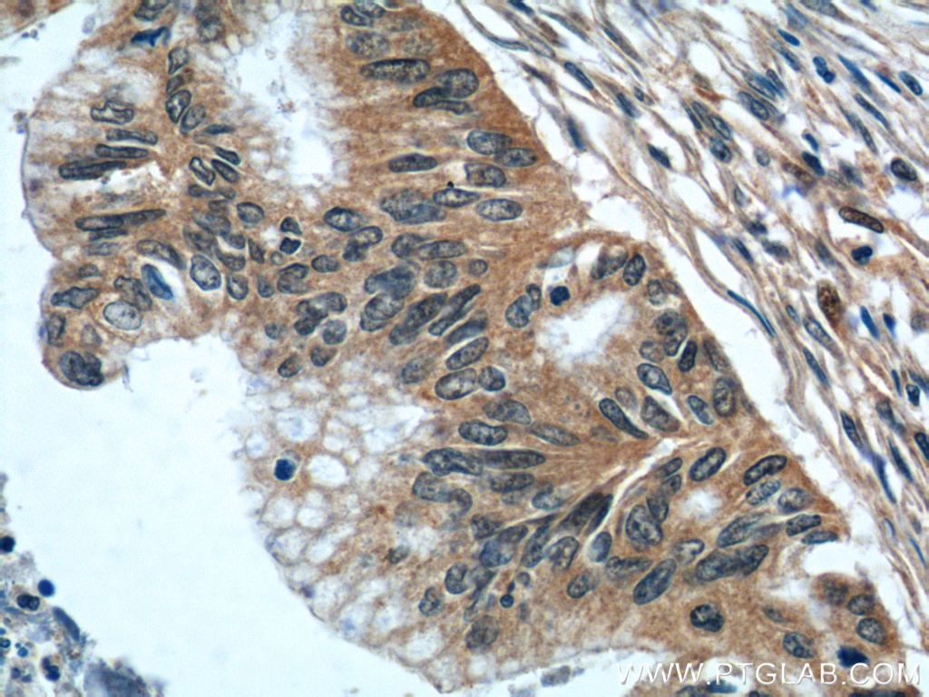 Immunohistochemistry (IHC) staining of human pancreas cancer tissue using Kindlin 1 Polyclonal antibody (22215-1-AP)