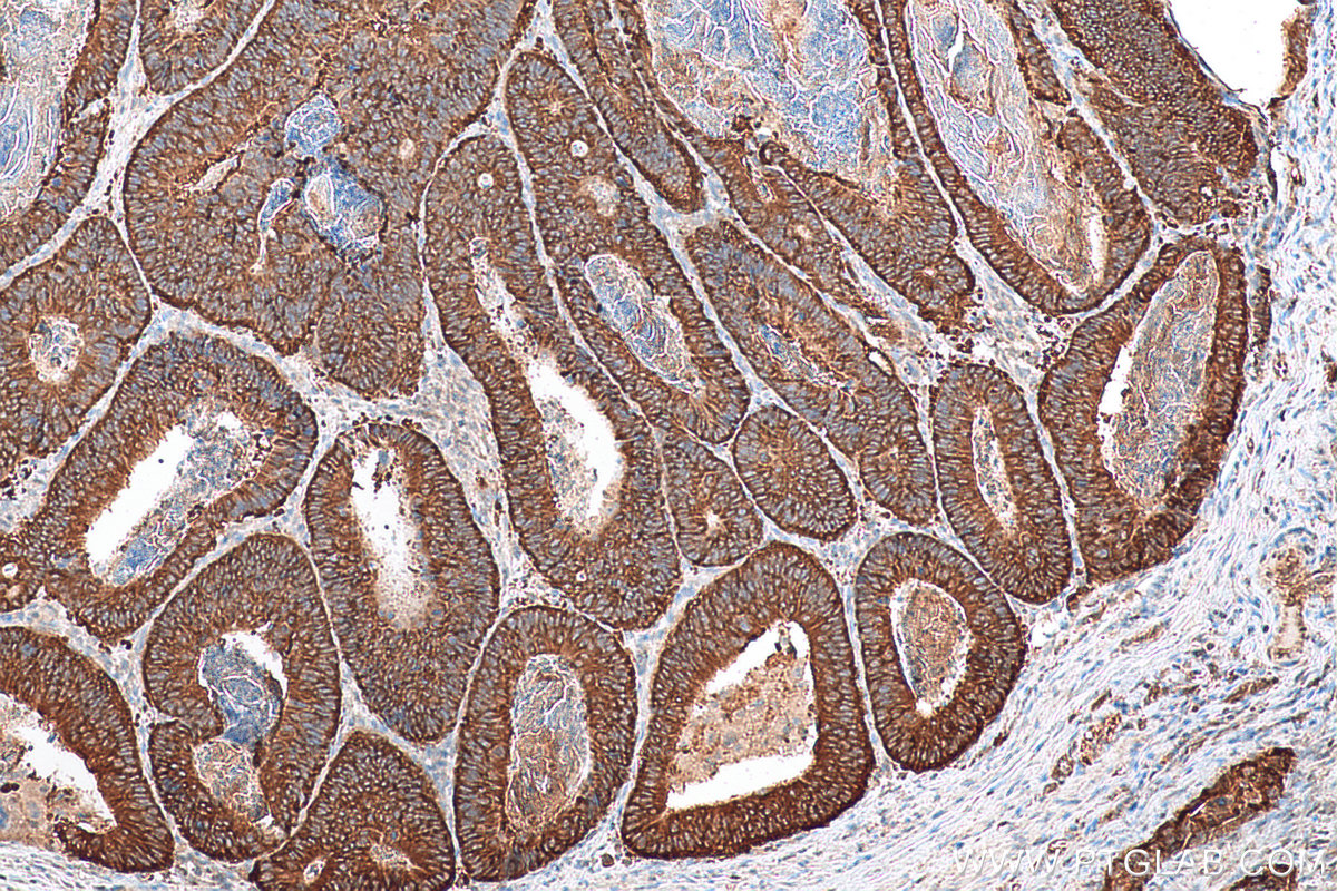 Immunohistochemistry (IHC) staining of human colon cancer tissue using Kindlin 1 Polyclonal antibody (22215-1-AP)