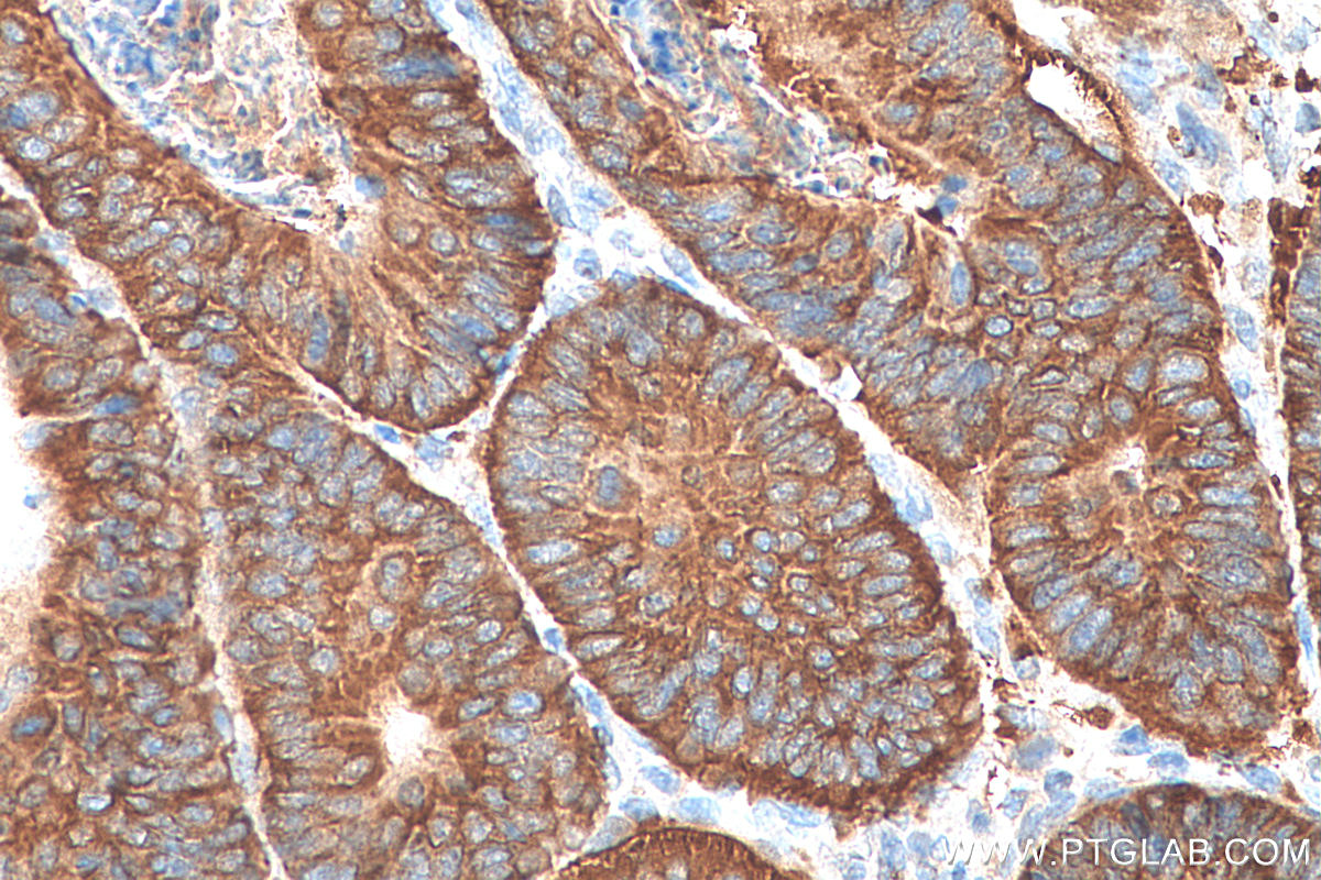 Immunohistochemistry (IHC) staining of human colon cancer tissue using Kindlin 1 Polyclonal antibody (22215-1-AP)