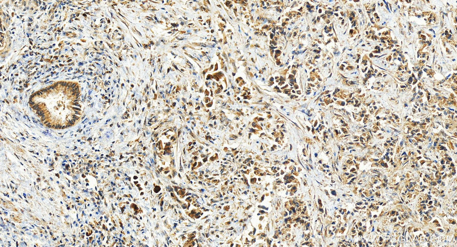 Immunohistochemistry (IHC) staining of human intrahepatic cholangiocarcinoma tissue using FGD2 Polyclonal antibody (27068-1-AP)