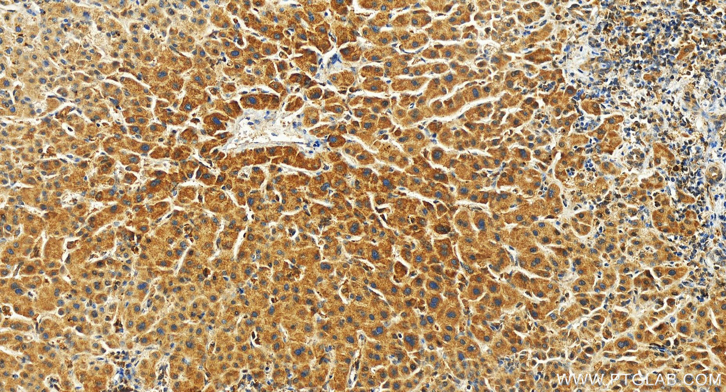 Immunohistochemistry (IHC) staining of human intrahepatic cholangiocarcinoma tissue using FGD2 Polyclonal antibody (27068-1-AP)