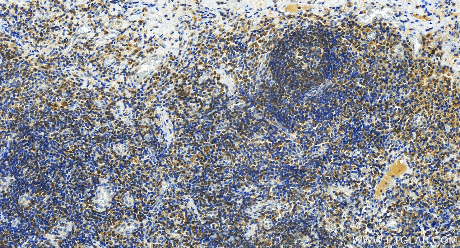 Immunohistochemistry (IHC) staining of human tonsillitis tissue using FGD2 Polyclonal antibody (27068-1-AP)