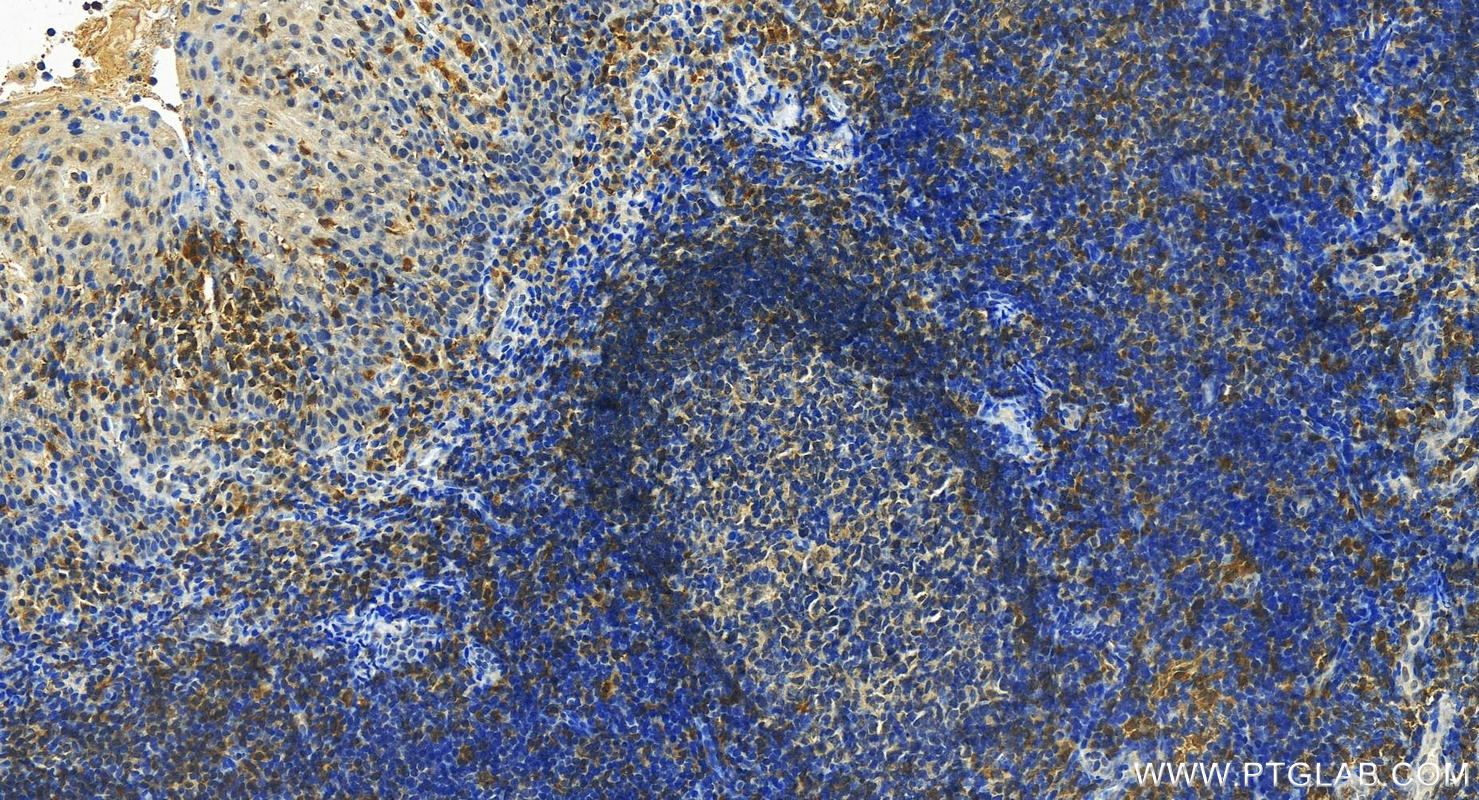 Immunohistochemistry (IHC) staining of human tonsillitis tissue using FGD2 Polyclonal antibody (27068-1-AP)