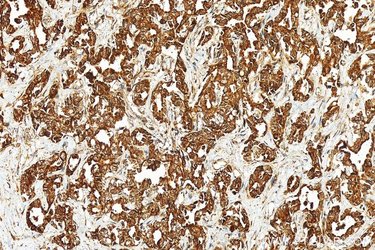 Immunohistochemistry (IHC) staining of human intrahepatic cholangiocarcinoma tissue using FGFR1OP2 Polyclonal antibody (11605-1-AP)