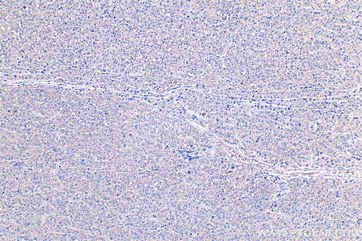 Immunohistochemistry (IHC) staining of human liver cancer tissue using Fibrinogen Gamma Chain Monoclonal antibody (66158-1-Ig)