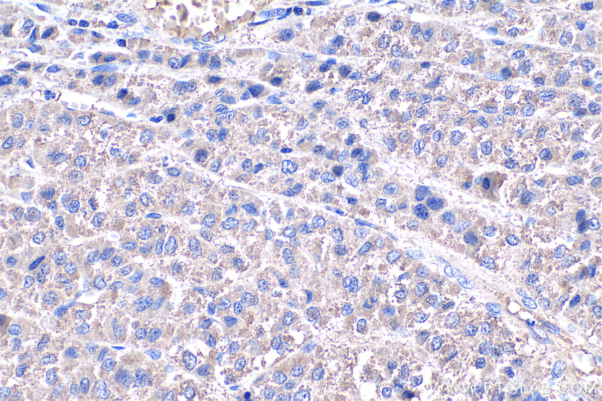 Immunohistochemistry (IHC) staining of human liver cancer tissue using Fibrinogen Gamma Chain Monoclonal antibody (66158-1-Ig)