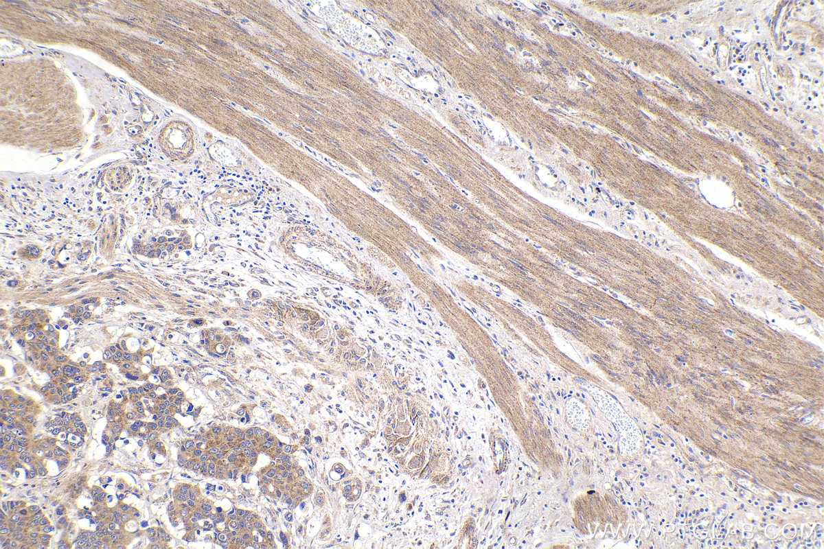 Immunohistochemistry (IHC) staining of human stomach cancer tissue using FH Monoclonal antibody (68162-1-Ig)