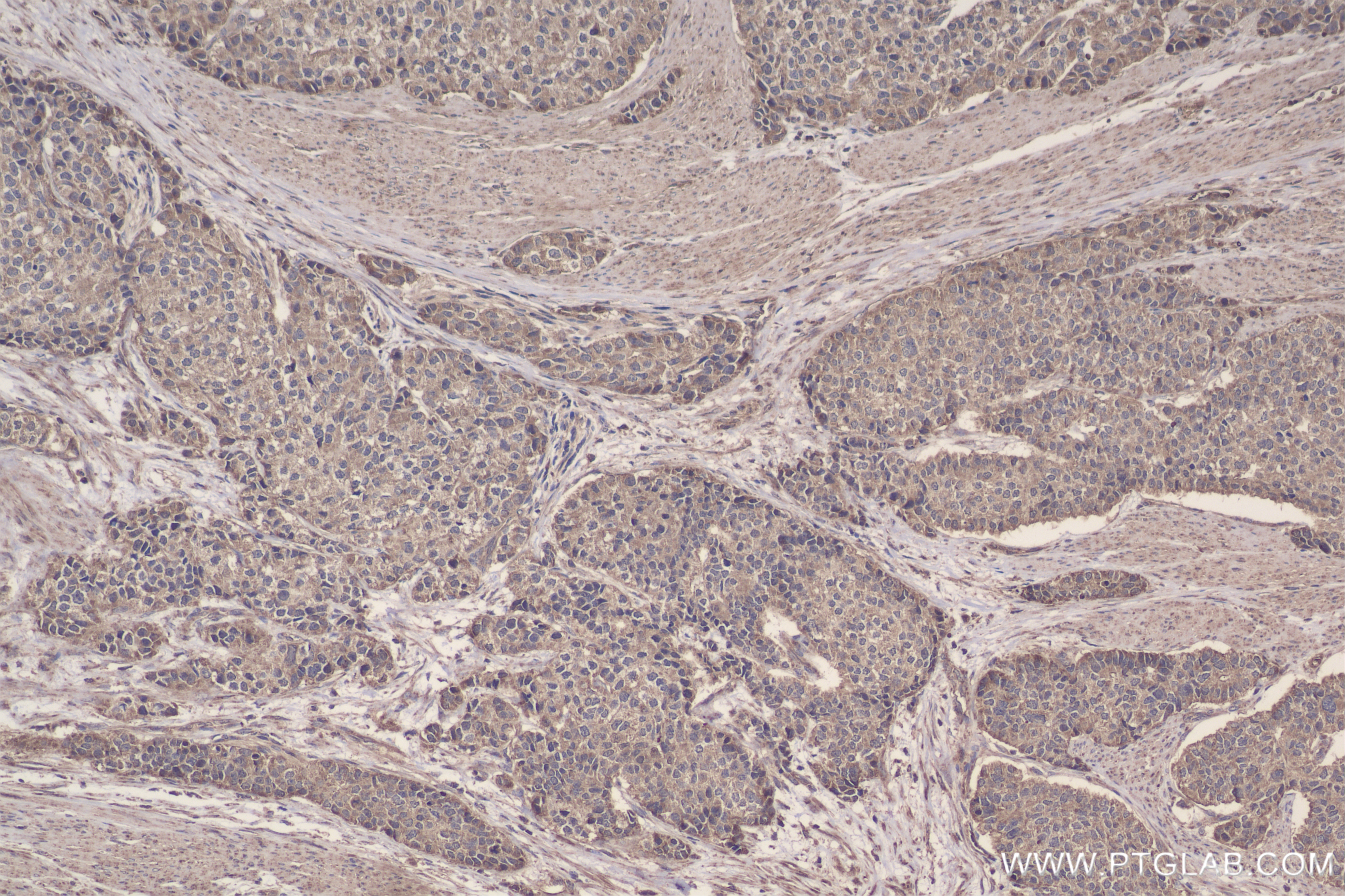 Immunohistochemistry (IHC) staining of human stomach cancer tissue using FH Recombinant antibody (82508-1-RR)