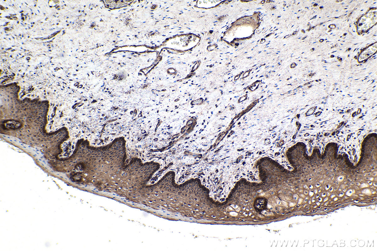 Immunohistochemistry (IHC) staining of human cervical cancer tissue using FHL2 Polyclonal antibody (21619-1-AP)