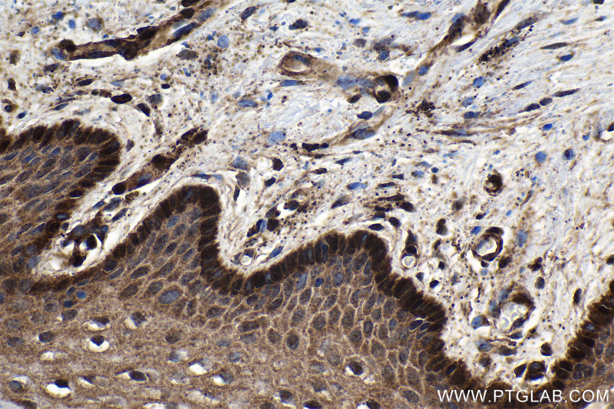 Immunohistochemistry (IHC) staining of human cervical cancer tissue using FHL2 Polyclonal antibody (21619-1-AP)