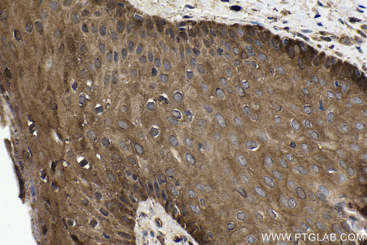 Immunohistochemistry (IHC) staining of human skin cancer tissue using FHL2 Polyclonal antibody (21619-1-AP)