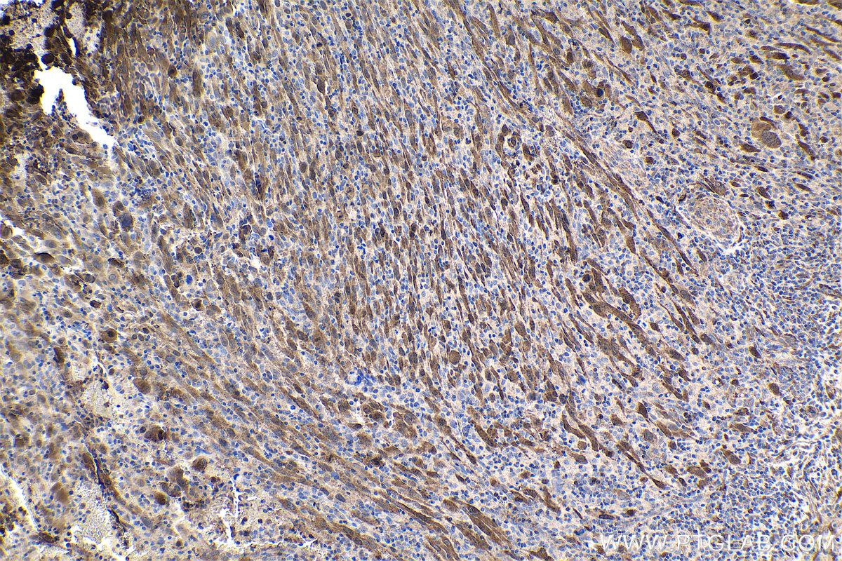 Immunohistochemistry (IHC) staining of human skin cancer tissue using FHL2 Polyclonal antibody (21619-1-AP)