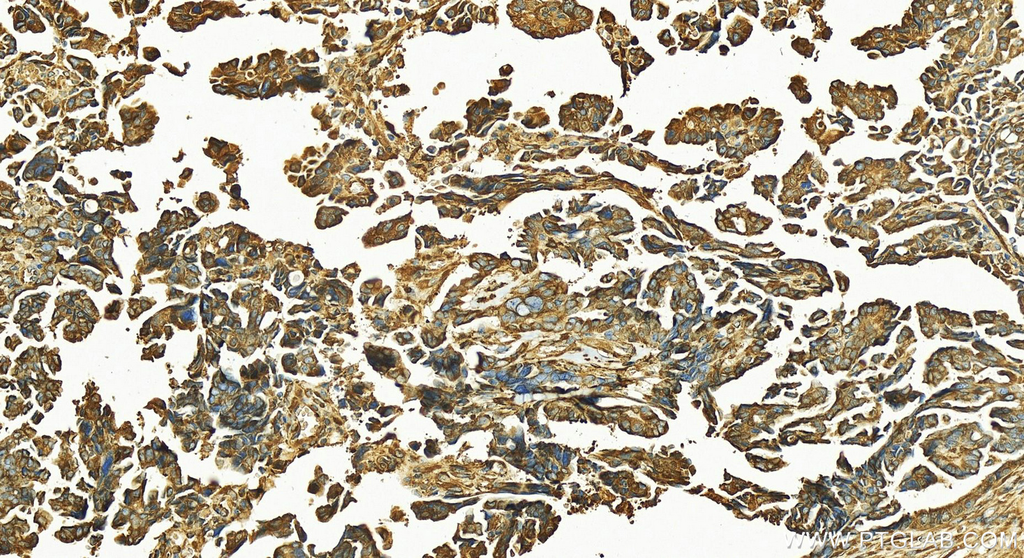 Immunohistochemistry (IHC) staining of human ovary cancer tissue using FKBP10/FKBP65 Polyclonal antibody (12172-1-AP)