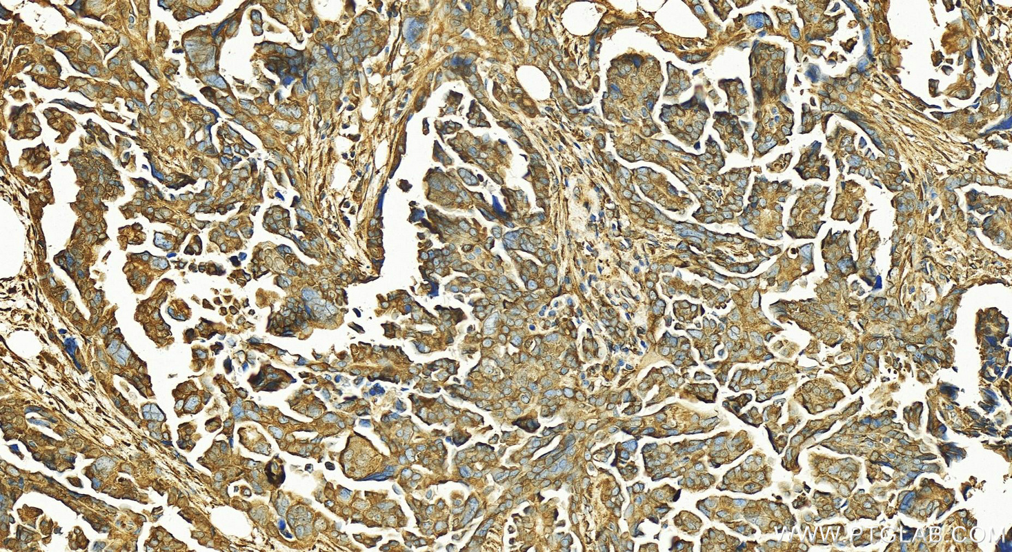 Immunohistochemistry (IHC) staining of human ovary cancer tissue using FKBP10/FKBP65 Polyclonal antibody (12172-1-AP)