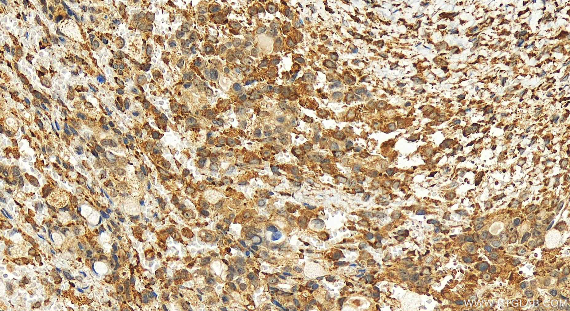 Immunohistochemistry (IHC) staining of human ovary cancer tissue using FKBP14 Polyclonal antibody (15884-1-AP)