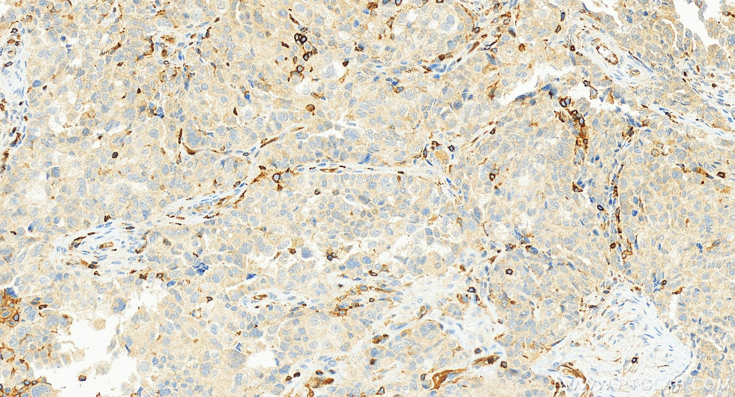 Immunohistochemistry (IHC) staining of human ovary cancer tissue using FKBP1A Polyclonal antibody (10273-1-AP)