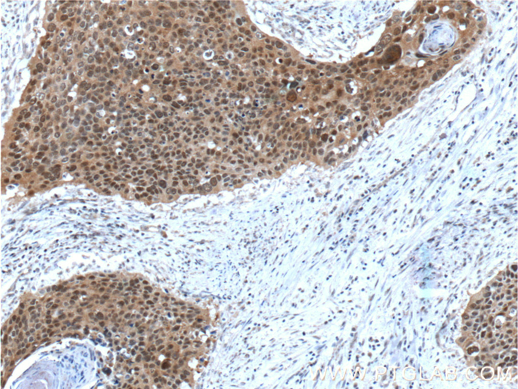 Immunohistochemistry (IHC) staining of human cervical cancer tissue using FKBP52 Monoclonal antibody (66040-1-Ig)