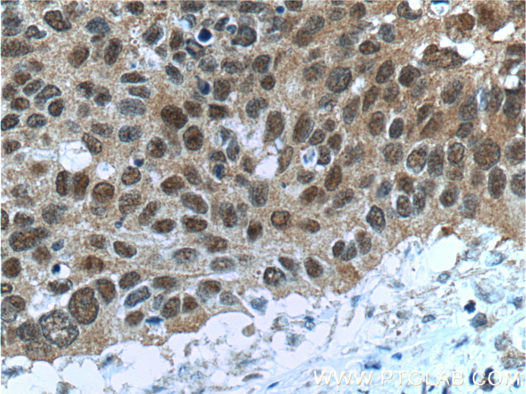 Immunohistochemistry (IHC) staining of human cervical cancer tissue using FKBP52 Monoclonal antibody (66040-1-Ig)